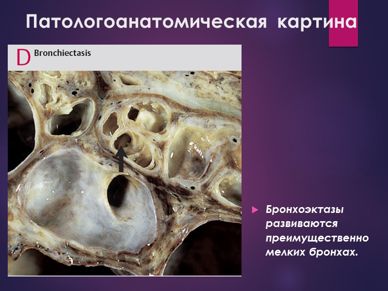 Патологоанатомическая  картина  Бронхоэктазы развиваются преимущественно мелких бронхах.